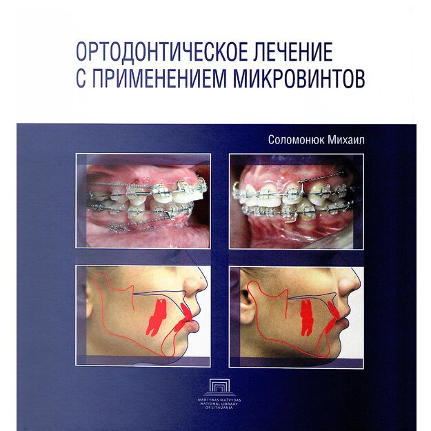 Ортодонтическое лечение с применением микровинтов
